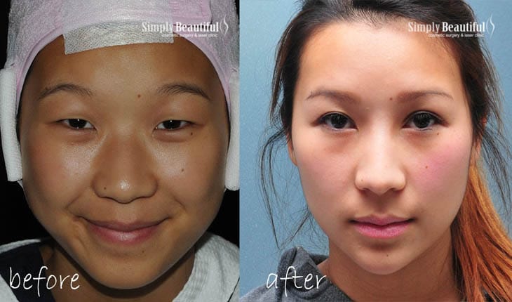 asian cosmetic surgery